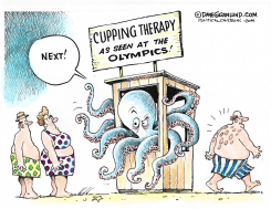 CUPPING THERAPY by Dave Granlund