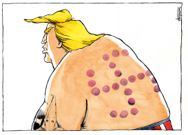 CUPPING MARKS ON TRUMP'S BACK by Michael Kountouris